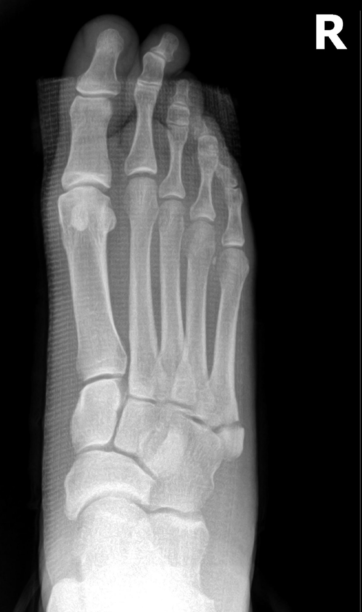 What Are Fifth Metatarsal Fractures Strash Foot Ankle Care