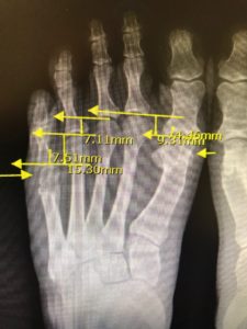 latrogenic short metatarsals strash foot and ankle