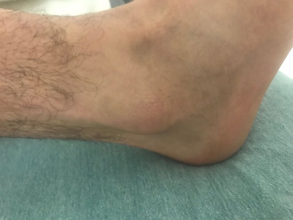 Strash Foot Ankle Care Subluxing Peroneal Tendons