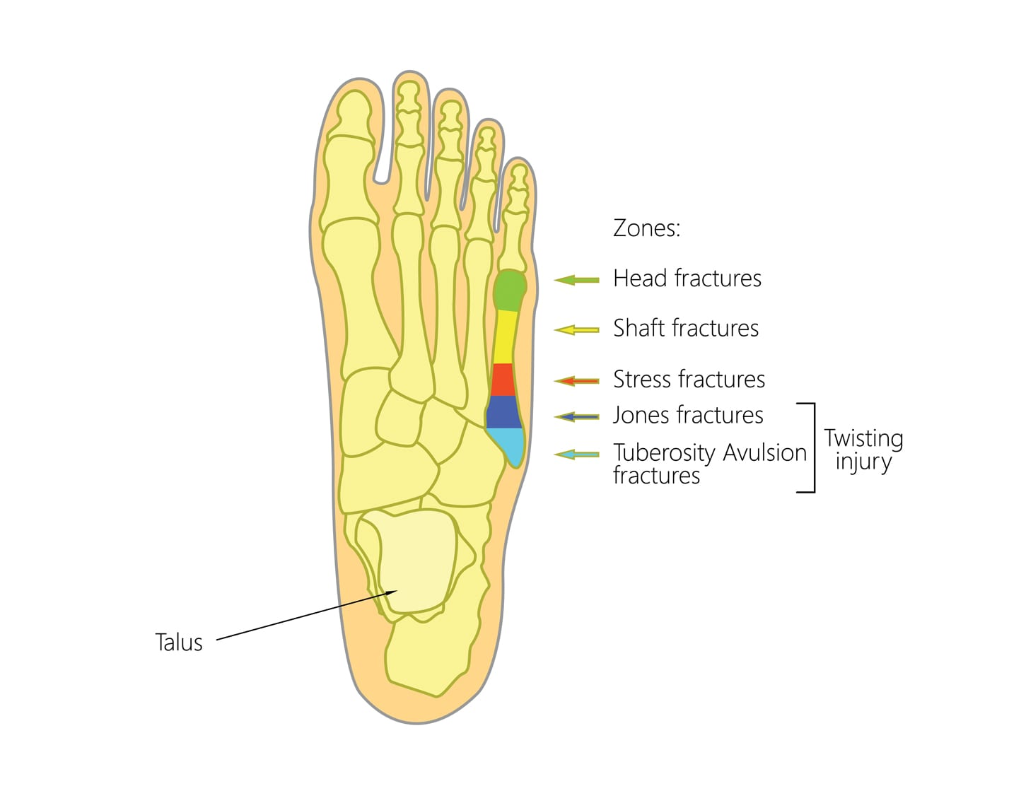 Strash Foot & Ankle Care | What are Fifth Metatarsal Fractures?